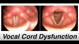 vocal cord dysfunction  Patient Education Video [upl. by Atinar441]