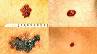 Atypical Moles or Melanoma The ABCDEs Dermatology [upl. by Eisen]