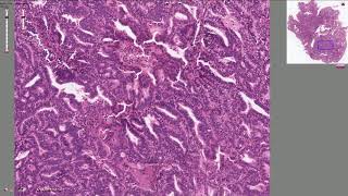 Endometrial Adenocarcinoma  Histopathology [upl. by Eulalee]