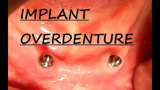 Implant Overdenture Planning  Part 1 Implant Supported Overdenture  Step by Step Planning [upl. by Savart946]