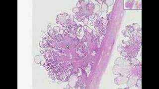 Histopathology OvarySerous cystadenoma [upl. by Aicemaj]