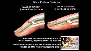 Distal Phalanx Fractures  Everything You Need To Know  Dr Nabil Ebraheim [upl. by Yoong748]