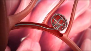 Neuro Embolization Procedure [upl. by Barlow]