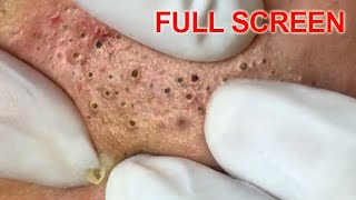 Blackheads removal  Best Pimple Popping Videos [upl. by Aurea]