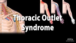 Thoracic Outlet Syndrome TOS Animation [upl. by Edith]