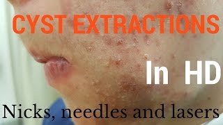 Cysts extractions blackheads  Removal methods in HD [upl. by Ahsyek849]