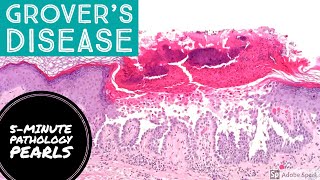 Grovers Disease Transient Acantholytic Dermatosis 5Minute Pathology Pearls [upl. by Venable]