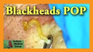 Blackheads POP  Auburn Medical Group [upl. by Katonah132]