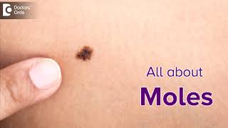 Mole or melanoma Spot the difference [upl. by Wendye]