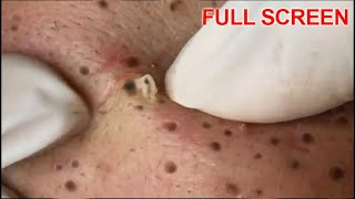 Blackheads Removal  Best Pimple Popping Videos [upl. by Friedrich227]