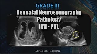 Neonatal Neurosonography  Pathology  IVH  PVL [upl. by Mirilla993]