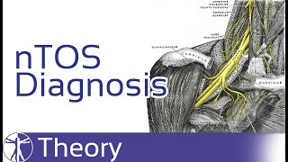 Neurogenic Thoracic Outlet Syndrome Diagnosis  nTOS [upl. by Atil]