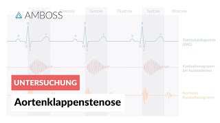 Aortenklappenstenose  Herzgeräusch  AMBOSS Video [upl. by Hook]