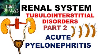 ACUTE PYELONEPHRITIS Pathology [upl. by Animrac]