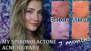 SPIRONOLACTONE FOR HORMONAL ACNE BEFORE  AFTER PICTURES MY EXPERIENCE AND WHY I STOPPED TAKING IT [upl. by Isidor]