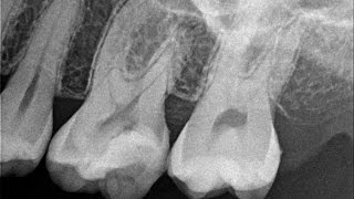 Root Canal Treatment Start to Finish Tooth 14 [upl. by Miguelita]