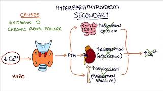 Understanding Hyperparathyroidism [upl. by Enelrihs]