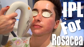 Rosacea Treatment with IPL Laser ft Eric Smith [upl. by Cida]