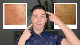 How to Get Rid of Acne Scars [upl. by Lehrer194]