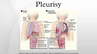 Pleurisy [upl. by Crosby]