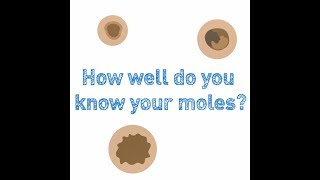 Atypical Moles What Are They Dermatology 2019 [upl. by Niak]