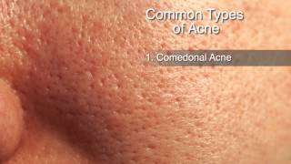 Acne Treatment Options [upl. by Adnalahs]