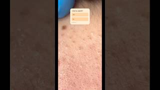 Blackhead pimple removal [upl. by Chapa]