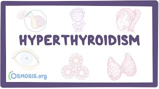 Hyperthyroidism  an Osmosis Preview [upl. by Sivlek799]