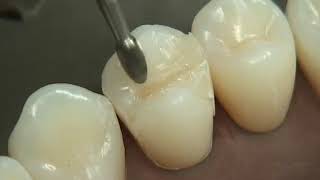 Class II Composite Preparation amp Restoration  Operative Dentistry [upl. by Nnarefinnej]