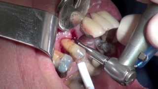 Immediate Dental Implant Surgery  Upper Premolar  Surgery Explicit [upl. by Sueddaht]