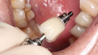 Full Contour Zirconia Implant Crown Insert [upl. by Hallvard]