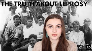 THE TRUTH ABOUT LEPROSY  A HISTORY SERIES [upl. by Ruffi48]