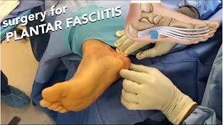 Plantar Wart Shaving Procedure [upl. by Cullan]