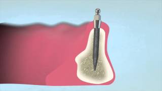 How to Place a 3M™ ESPE™ MDI Mini Dental Implant [upl. by Bowler]