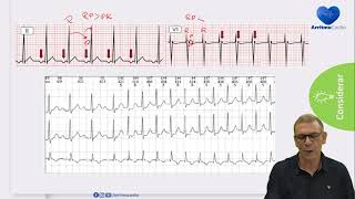 Taquicardia Supraventricular x Taquicardia Sinusal [upl. by Courtund792]