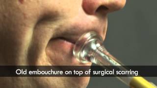 Trumpet embouchure before and after surgery [upl. by Palladin929]