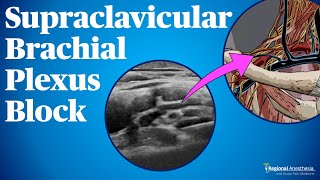 Supraclavicular Brachial Plexus Block [upl. by Analiese]