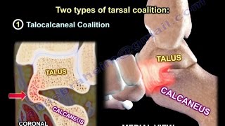 Tarsal Coalition  Everything You Need To Know  Dr Nabil Ebraheim [upl. by Kaitlynn]