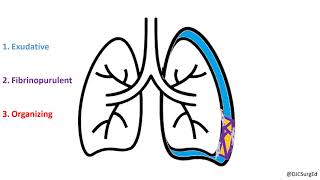 Empyema and Pleural Effusions [upl. by Enahc]