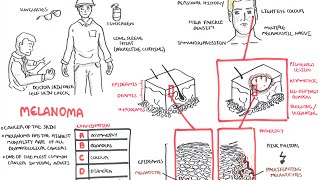 Melanoma  Overview signs and symptoms pathology risk factors treatment [upl. by Zea]