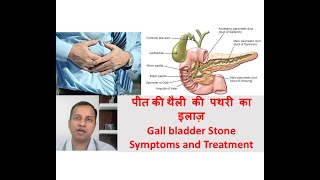 Gall bladder stone symptoms treatment in Hindi By Dr Vikas Singla [upl. by Deva]