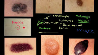 Melanocytic Lesions Part 2 [upl. by Alethea356]