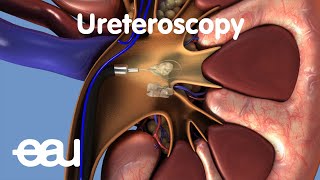 Removal of kidney stones URS [upl. by Cilo]