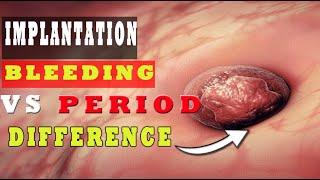 Implantation Bleeding Vs Period – How to Know the Difference 🩸🩸 [upl. by Stubstad]