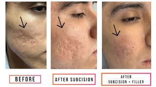 Subcision  Filler for Acne Scars [upl. by Ezra961]