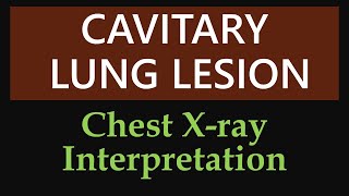 Cavitary Lung Lesion  Chest Xray Interpretation [upl. by Esirahc]