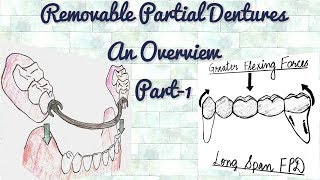 Removable Partial DenturesAn Overview Part1Indications of RPD [upl. by Nessie381]