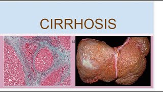 Cirrhosis [upl. by Dnallor]