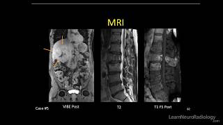 Neuroradiology spine lesions  Case 5  overview  Choose your own adventure [upl. by Christopher]