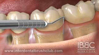 Periodontal disease causes and treatment [upl. by Alaikim]